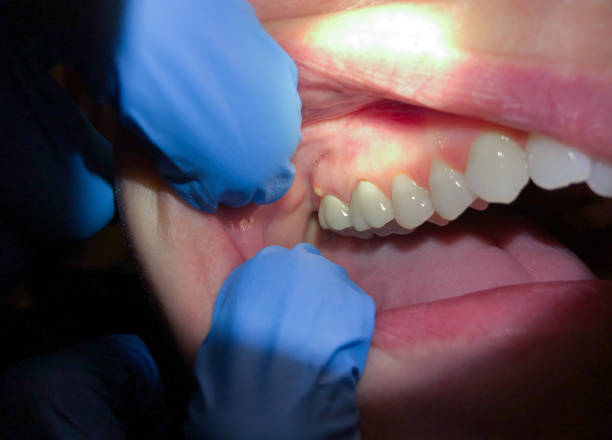 Best Emergency Root Canal Treatment in Putney, GA